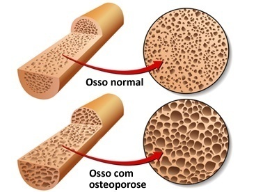 Você cuida de seus ossos?